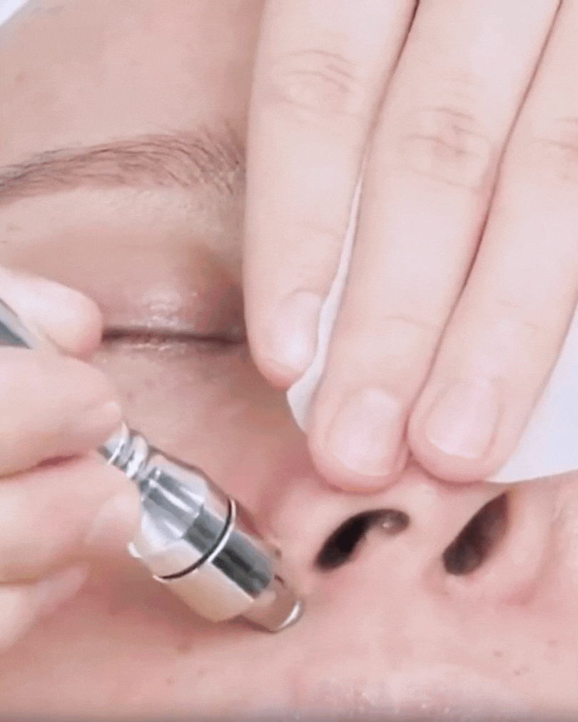 💎 El Secreto de la Piel Glow: Microdermoabrasión + Hidratación Nano desde Casa
